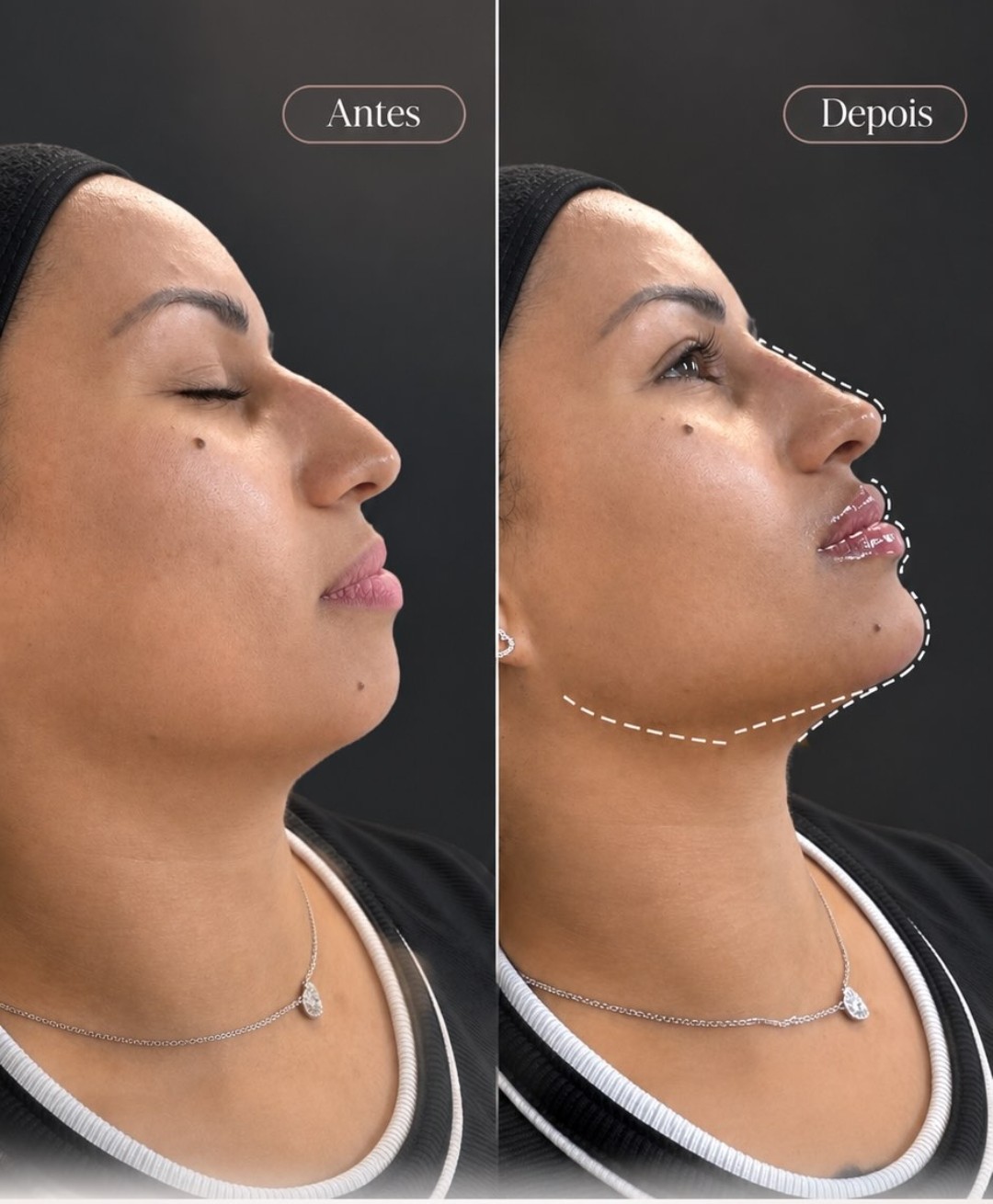 Resultado de harmonização facial - antes e depois