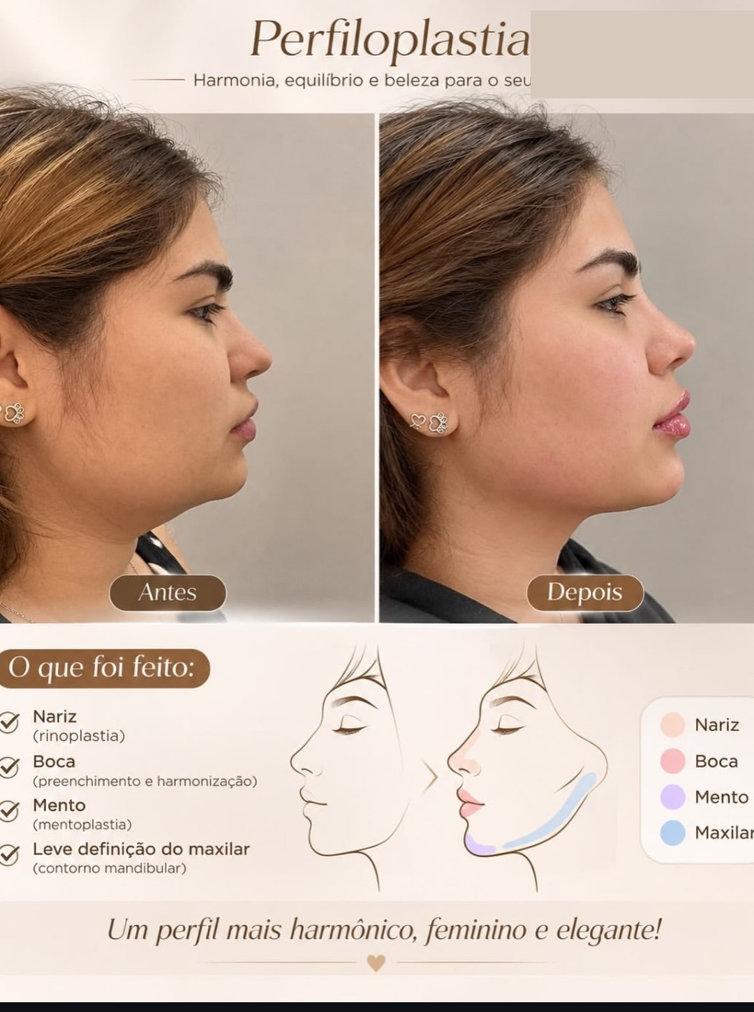 Perfiloplastia - antes e depois, nariz, boca e mento